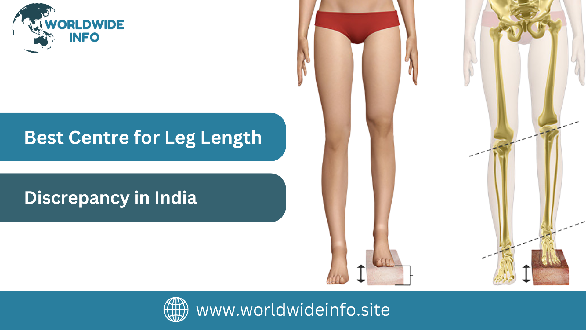 Best Centre for Leg Length Discrepancy in India